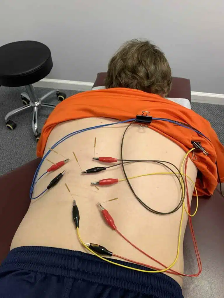 Patient having a dry needling treatment in a chiropractic clinic