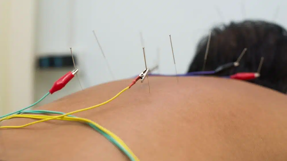 Patient having a dry needling treatment in a chiropractic clinic