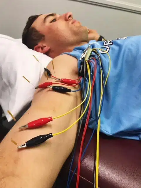 Patient having a dry needling treatment in a chiropractic clinic