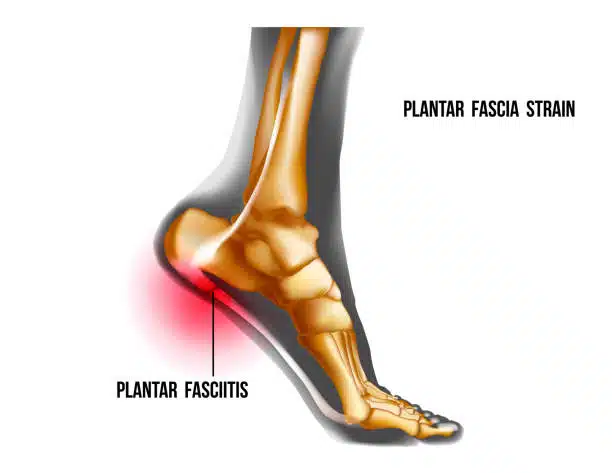 Plantar fasciitis inflammation and ruptures strain. Bones ot Foot pain realistic illustration. Medial view. Anatomy of joints, human leg black and yellow transparente skeleton. For medical orthopedic advertising. Vector illustration stock vector.