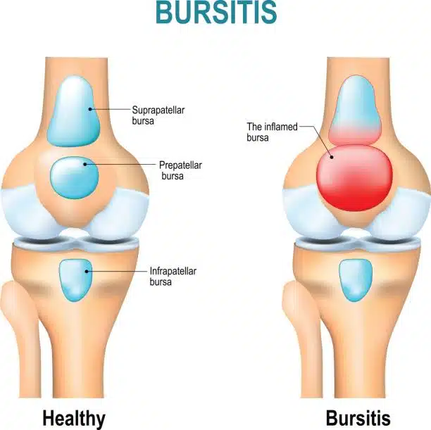 Bursitis concept